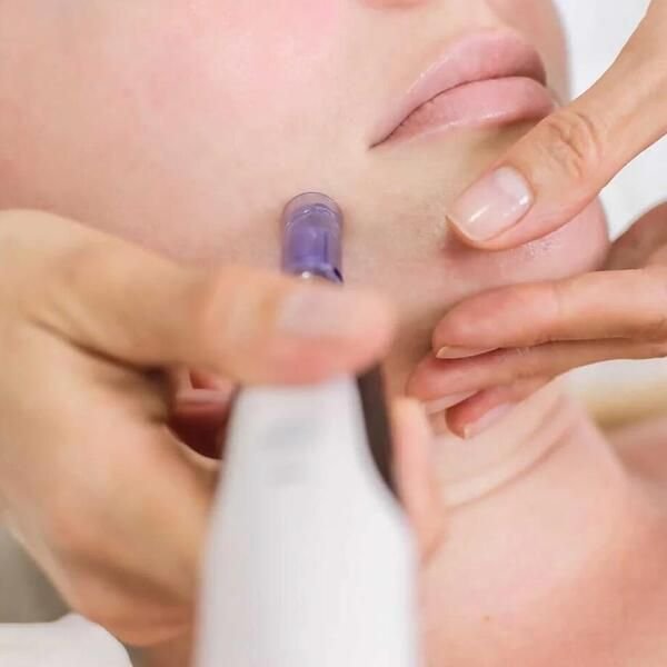 microneedling