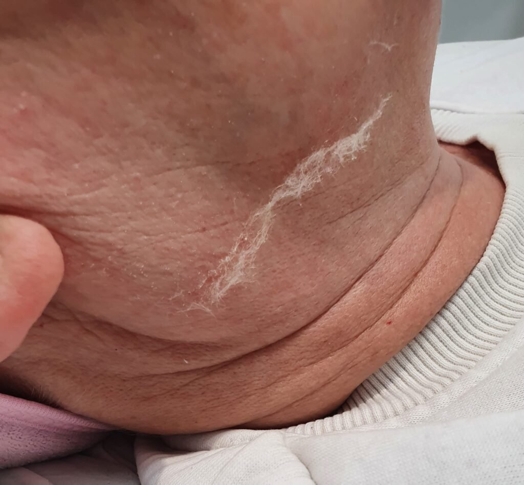dermaplaning