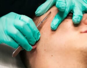 radiesse (caha) dermal filler