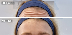 botox