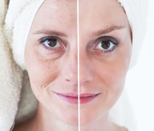 wrinkle softening