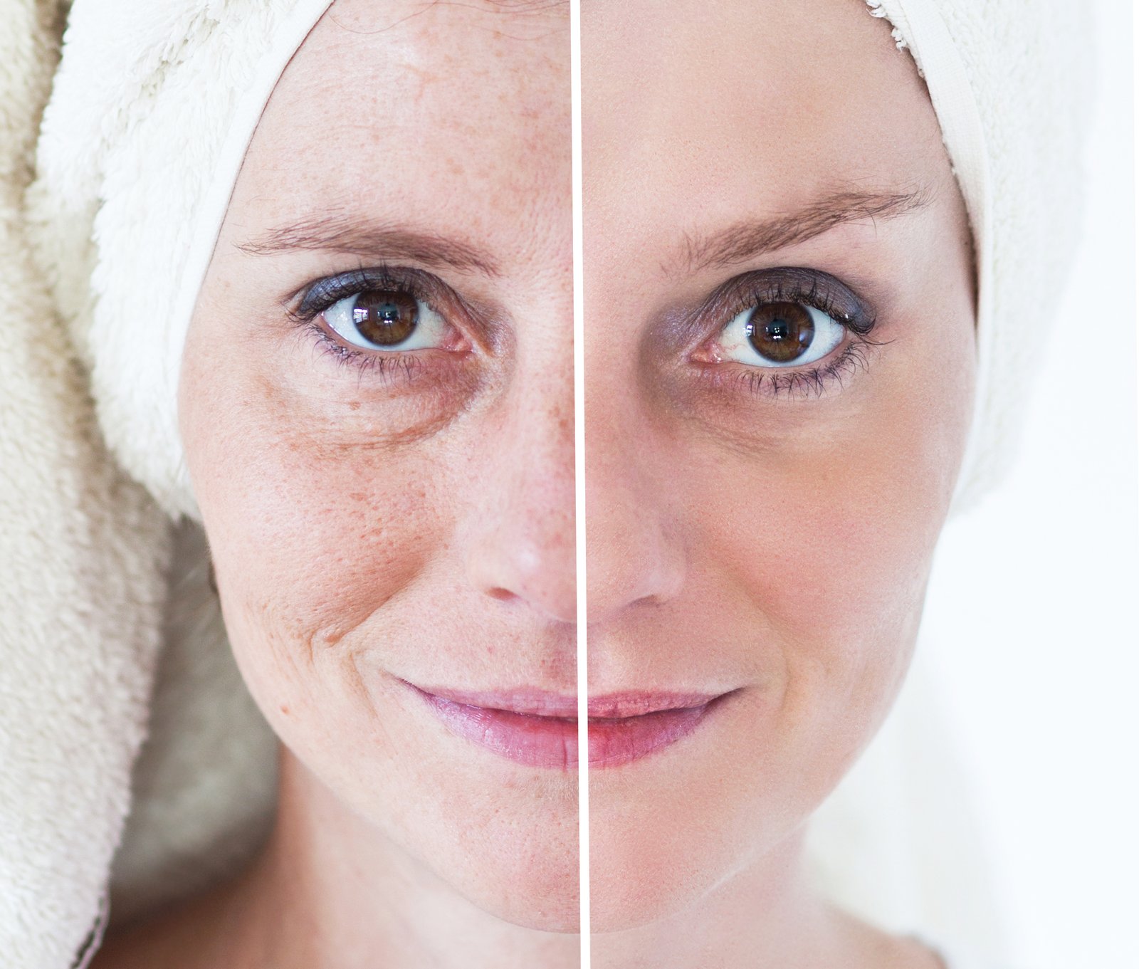 wrinkle softening